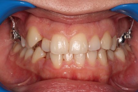 Aparat_Fix_5435